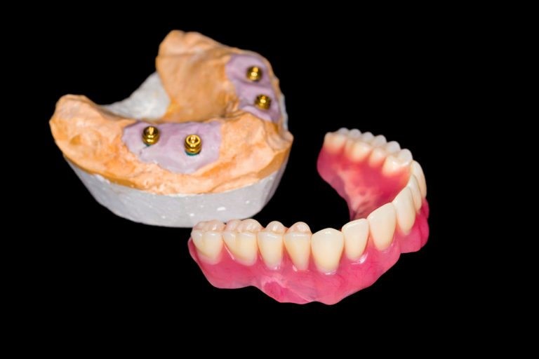 Snap In Dentures Bogue Chitto MS 39629